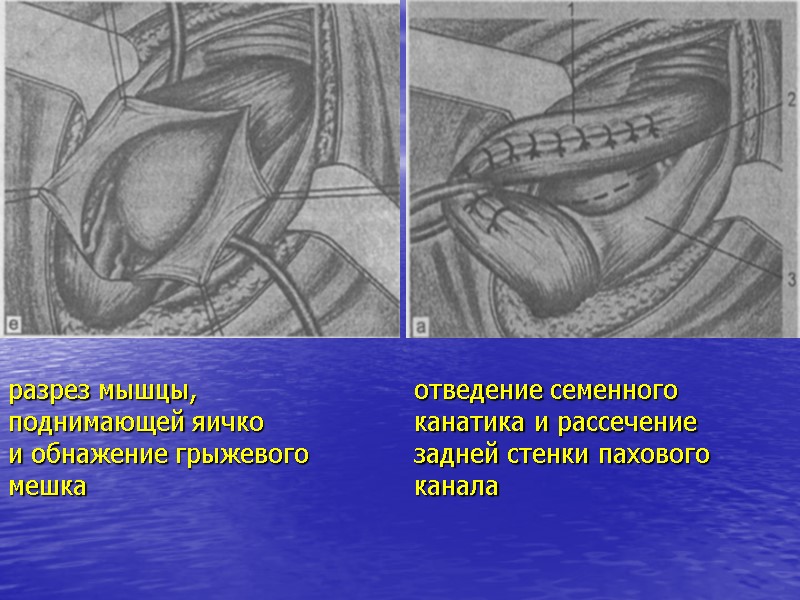 разрез мышцы,  поднимающей яичко и обнажение грыжевого  мешка отведение семенного  канатика